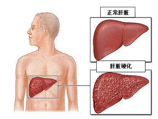 乙肝怎么預防肝硬化和肝癌?
